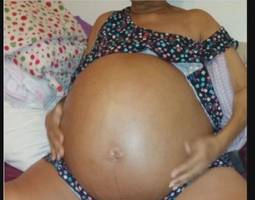 Doctors Agree to Operate on Uninsured Woman, Remove 27-Pound Tumor from Stomach